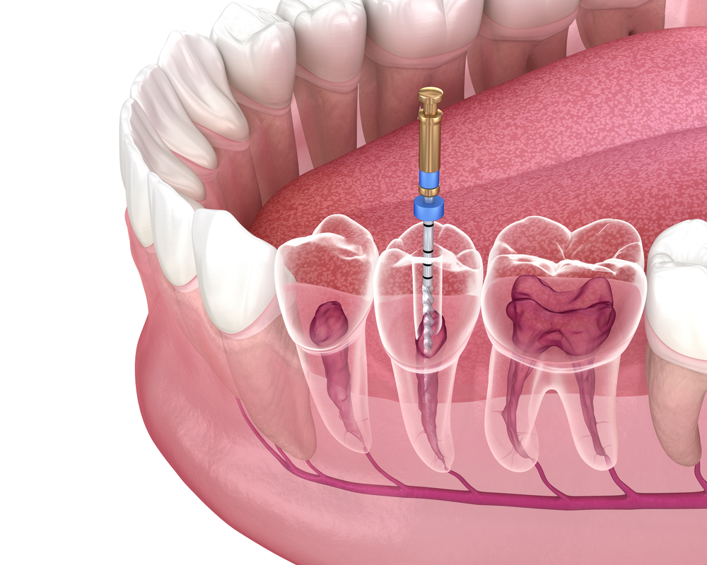 Root Canals on Hastings