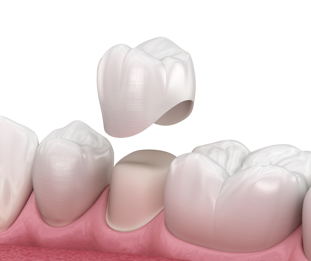 Dental Crowns on Hastings