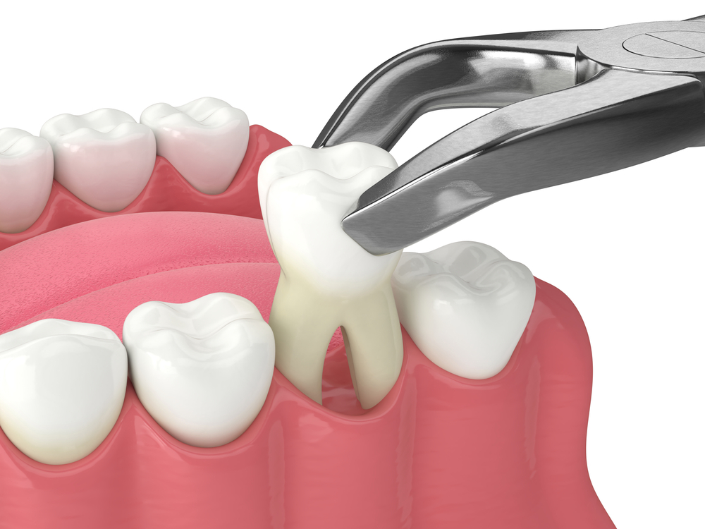 Tooth Extractions on Hastings