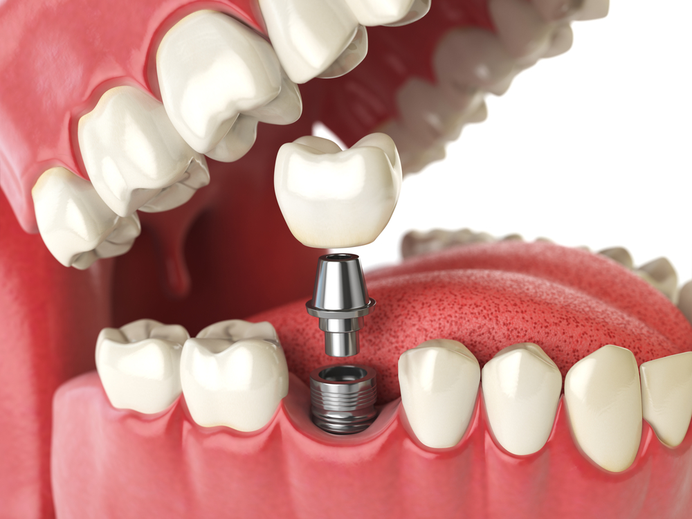 Dental Implants on Hastings